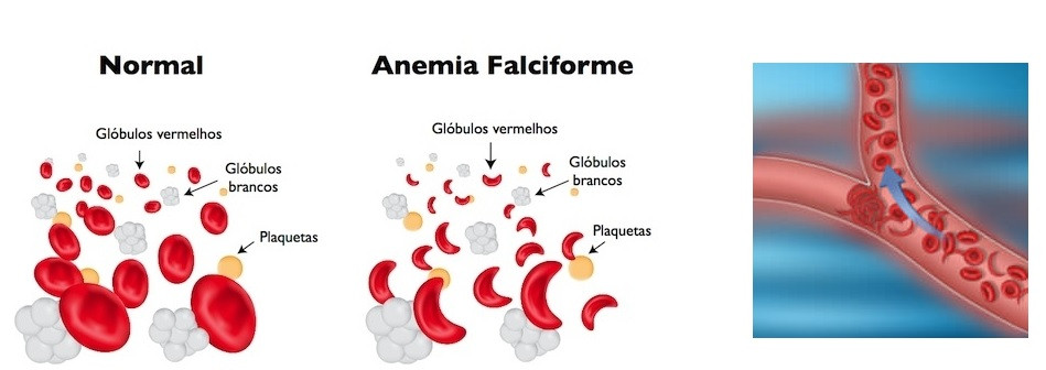 Cellule falciformi